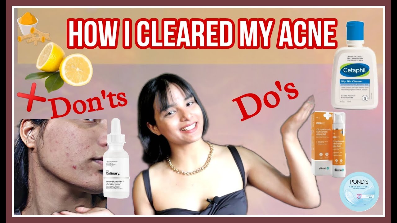 How I cleared my acne | skincare for acne prone skin | Snazzy Sakshi ...