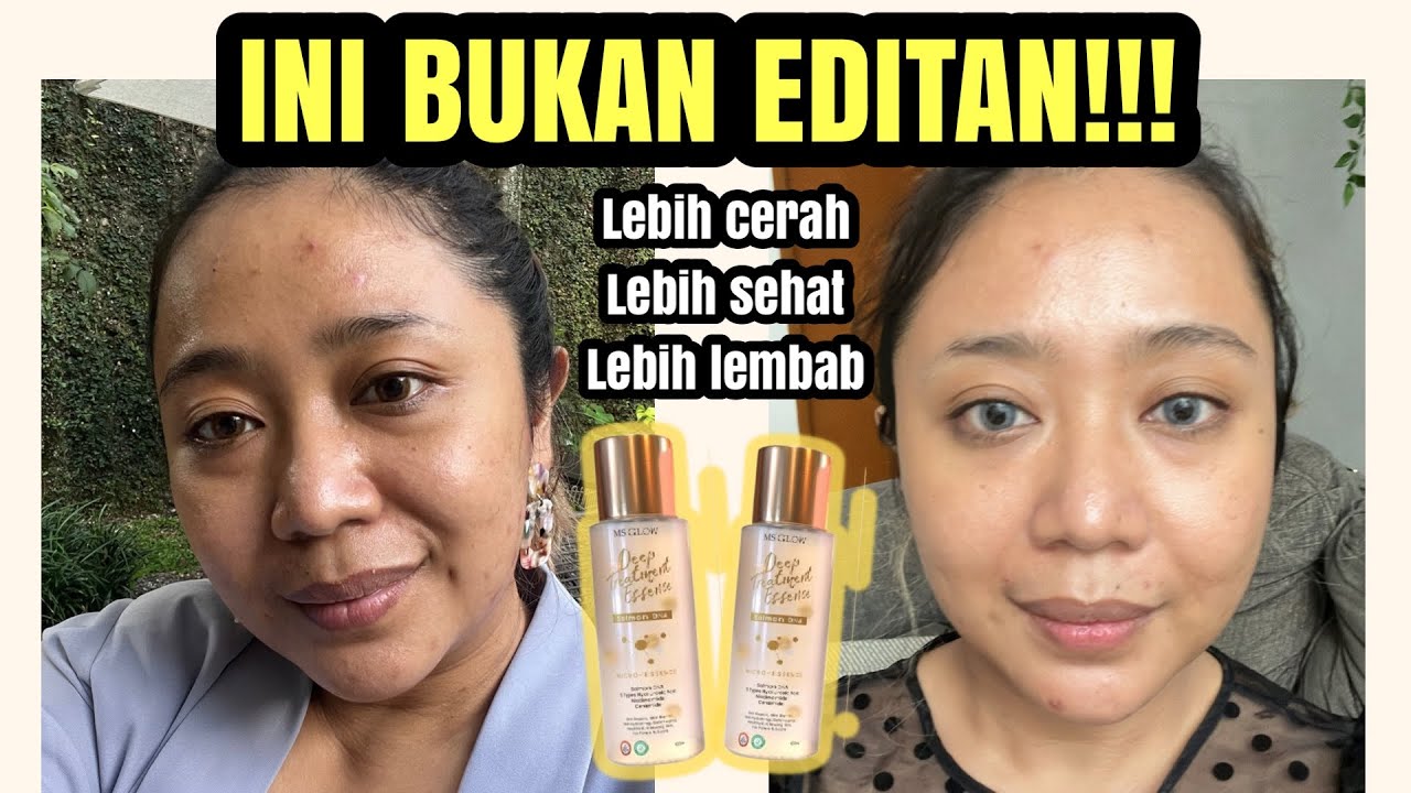 REVIEW JUJUR MS GLOW SALMON DNA DEEP TREATMENT ESSENCE DI KULIT ACNE