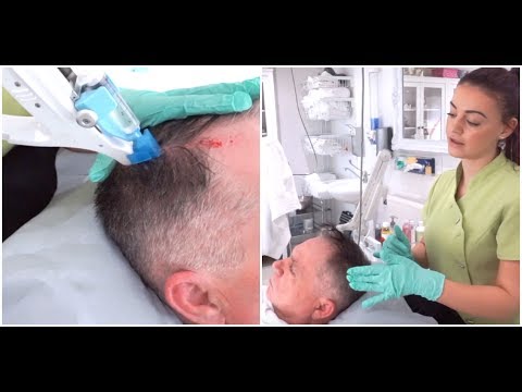 Video: Haarverlies: Oorzaak, Behandeling, Preventie En Meer