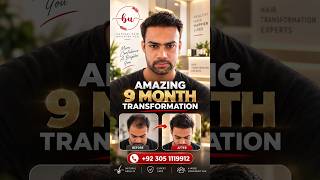 9 Months Hair Transplant Results in Lahore | Beauty Up Aesthetics #Shorts