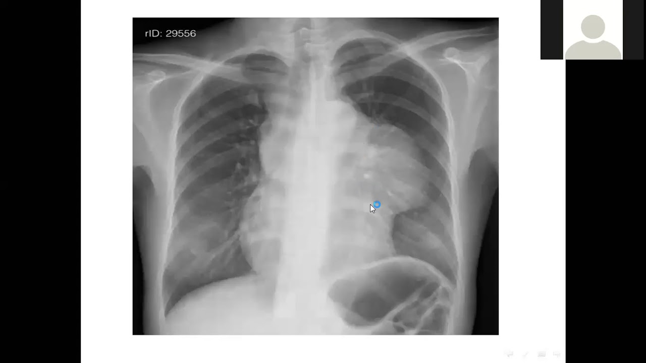 Lecture 14A Systematic Approach to Chest XRay part 2 د نزار شلاكة