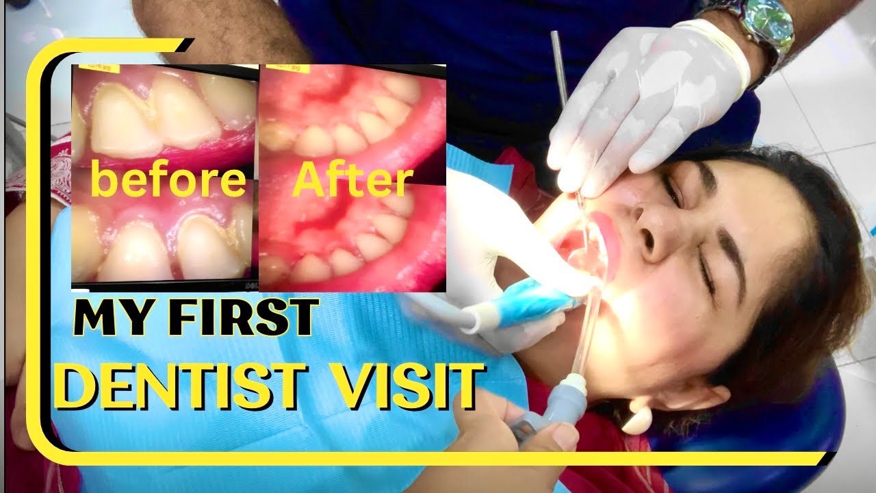 Removing Years of Plaque Teeth Scaling and Polishing Journey dentist