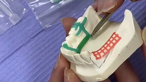 Class II Wax Pattern R.P.D : شرح عملى