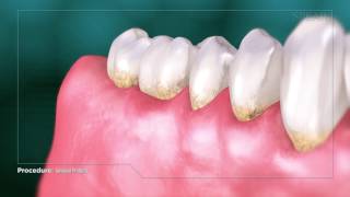 Gingival Probing and Pocket Depth.flv