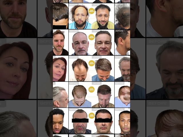 #shorts 2,870 grafts later… and suddenly the mirror is in a better mood. 👀