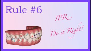 IPR , do it right!  - Invisalign Mini Course 7 of 8 part II