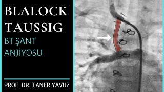 Fallot Tetralojisi Bt Şant