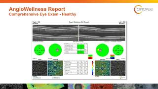 How to Get Started with OCT Angiography
