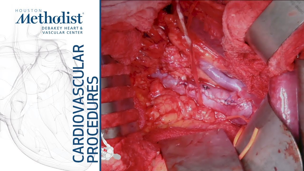 Open Ivc Filter Removal (Maham Rahimi, Md, And Mujeeb Zubair, Md)