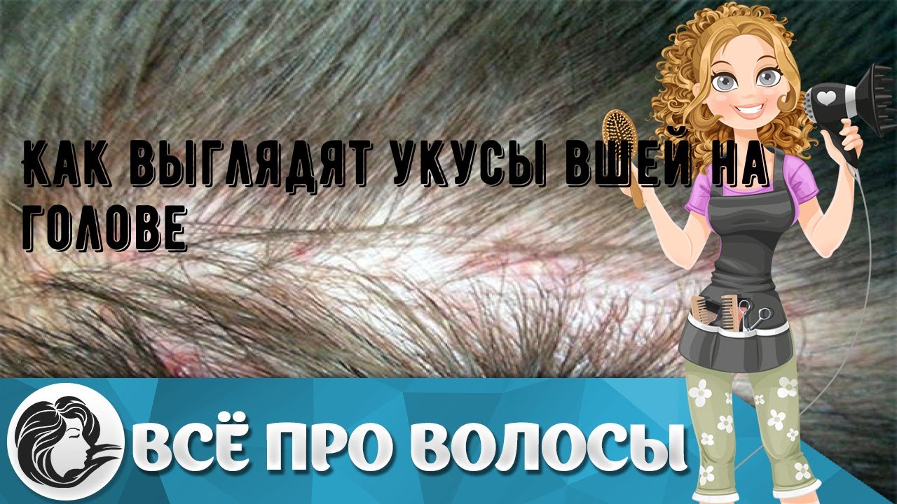 Как выглядят укусы вшей на голове - YouTube