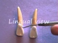 Maxillary Lateral Incisor Anatomy