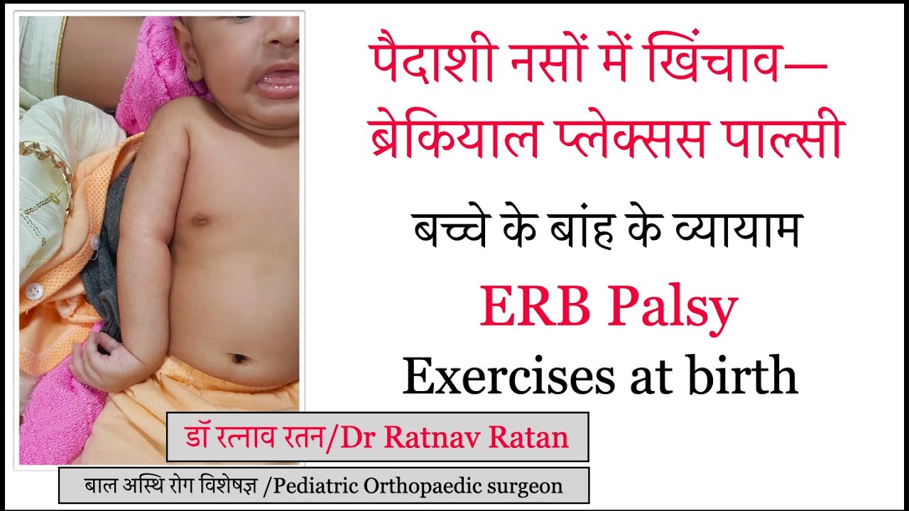 𝐄𝐫𝐛'𝐬 𝐏𝐚𝐥𝐬𝐲 𝐞𝐱𝐞𝐫𝐜𝐢𝐬𝐞𝐬 𝐚𝐭 𝐛𝐢𝐫𝐭𝐡|पैदाशी नसों में खिंचाव|बच्चे के बांह के व्यायाम|𝐃𝐫 𝐑𝐚𝐭𝐧𝐚𝐯 𝐑𝐚𝐭𝐚𝐧