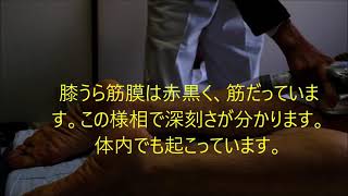 皮膚と筋膜の収縮は足裏病