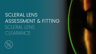 Assessing Scleral Lens Clearance | Contacts with Conway