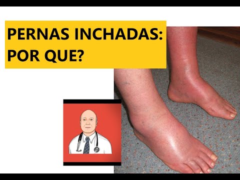 As 9 causas principais de pernas inchadas, com sinais de alerta para ver o médico.