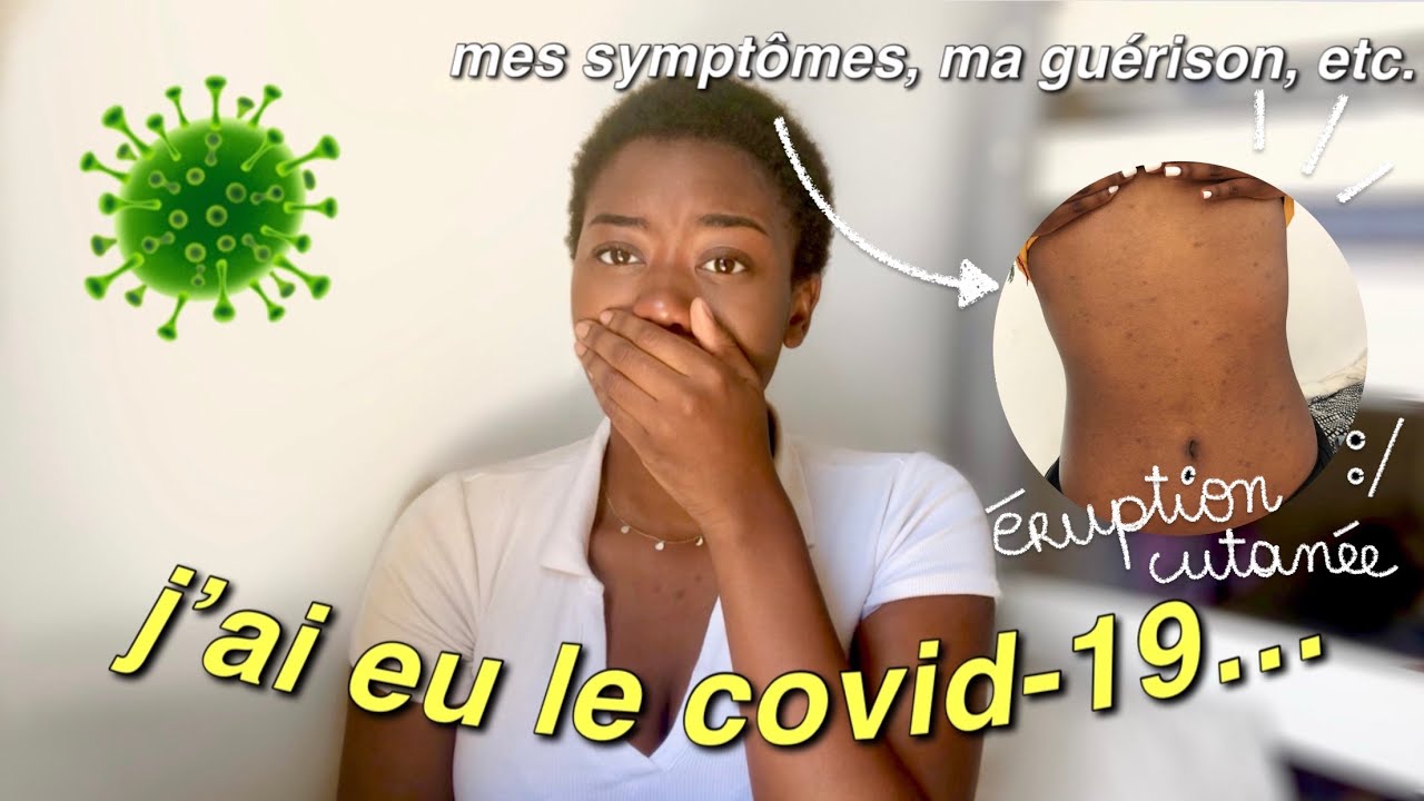 j'ai eu le covid : mes symptômes (éruption cutanée) et ma guérison