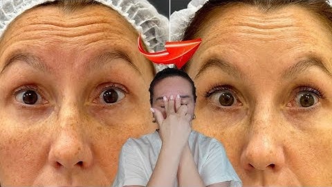 Effective techniques for FOREHEAD WRINKLES | Best results from our clients