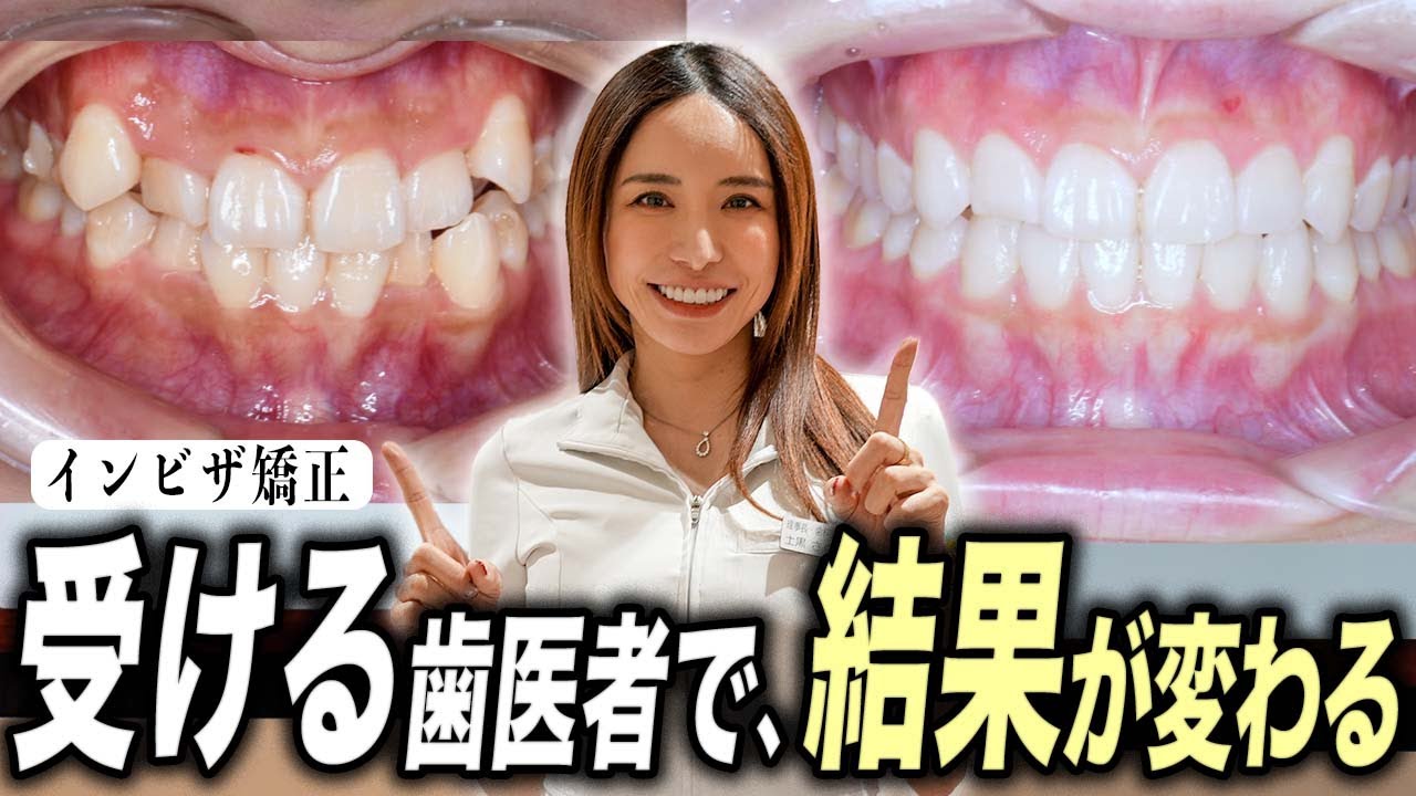 【失敗しないで…】インビザライン矯正はどこでやっても同じ？歯医者が解説します【ワイヤー矯正｜マウスピース矯正｜歯列矯正】