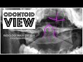 Radiology Image Critique: Odontoid View