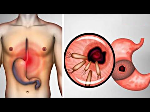 How to Kill Bacteria That Cause Heartburn Bloating and Reflux!