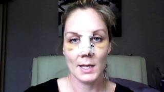 Septoplasty Recovery - day 6 blooper!!