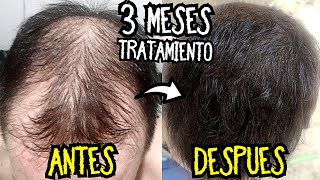 Recuperar el CABELLO en 3 MESES ¡RESULTADOS TRATAMIENTO Calvicie! | Minoxidil Antes y Despues