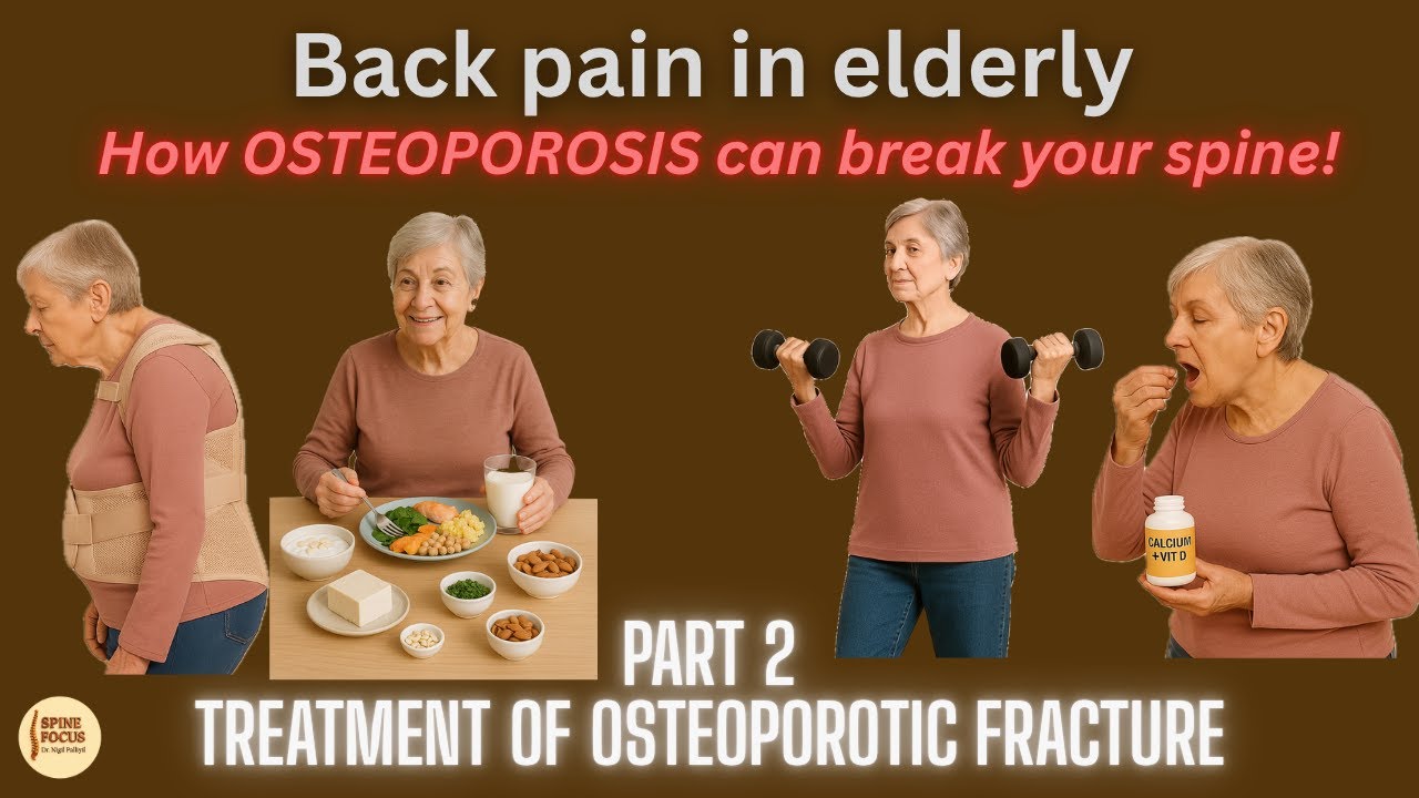 How to Treat Osteoporotic Spine Fractures Without Surgery | Osteoporosis & Spine Health