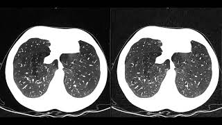 Pixelshine and Lung Cancer Screening Study