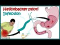 H Pylori Sidee Loo Daaweeyo Hpylori 