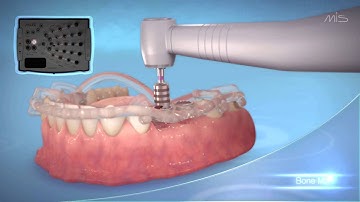 MIS Implants MGUIDE- guided Implant placement procedure