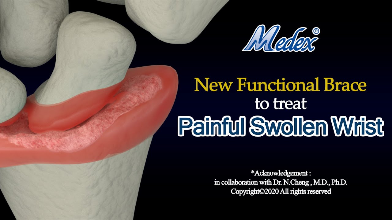 W02b New Functional Brace to treat Painful Swollen Wrist (3D