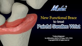 W02b - New Functional Brace to treat Painful Swollen Wrist (3D Animation)