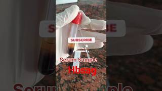 Hepatitis b |Hbsag test | hbsa test kit procedure | #hbsag treatment#  shorts#medical#viral|vlog#