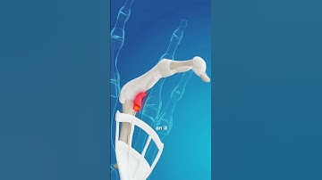 Trigger Finger Release Surgery (3D Animation)#triggerfingerrelease #triggerfinger #doctor