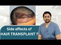 What are the side effects of hair transplant  by dr ankit khasgiwala indore