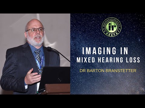 TMT: Mixed Hearing Loss by Dr Barton Branstetter
