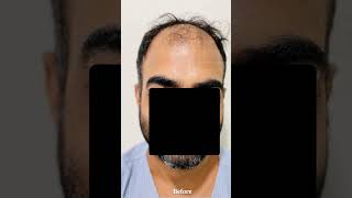 Can Lost Hair be Grown Back? 🤔 #shorts #hairloss #hairgrowth
