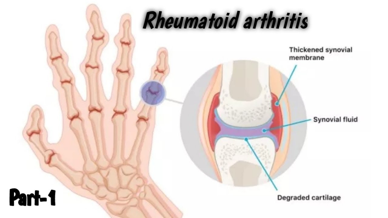 Rheumatoid Arthritis,definition,epidemiology,etiology,Predisposing