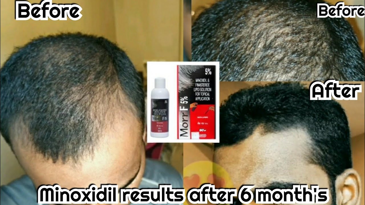Minoxidil awesome results after 6 month's of use. Minoxidil results ...