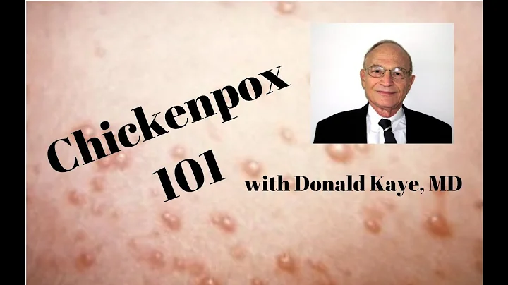 Chickenpox 101 with Donald Kaye, MD