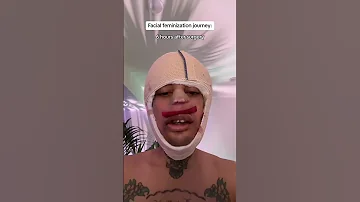 Facial Feminization Results Over 3 Months Trans Facialfeminizationsurgery 