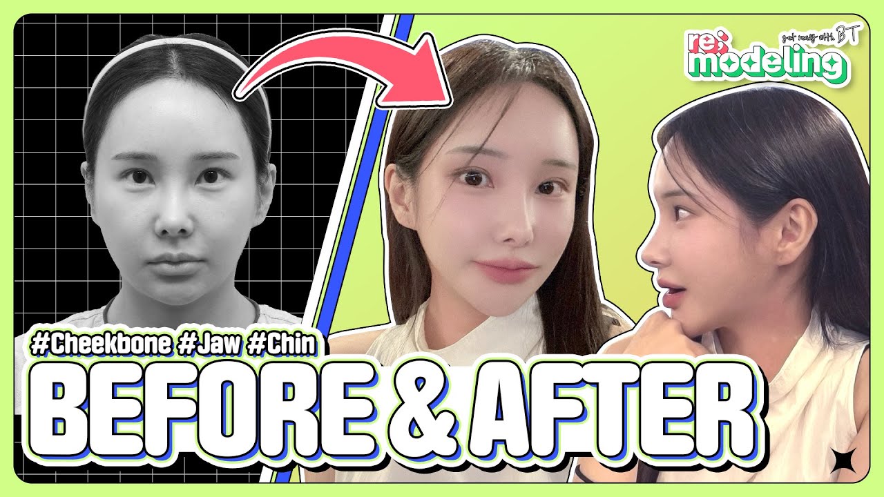 顔の外科 = FACIAL SURGERY Cheekbone Reduction, V line Jaw Surgery, Genioplasty Results