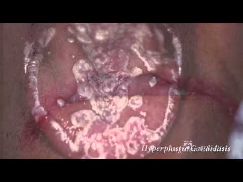oral-mucosal-diseases