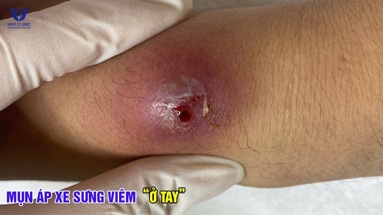 Ô áp xe căng như muốn nổ – Bác sĩ ấn nhẹ đã trào dịch.