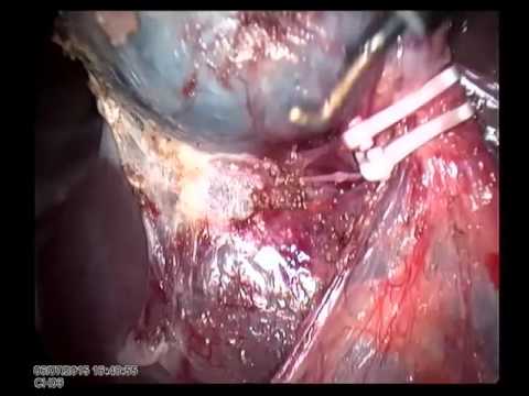 Lap Cholecystectomy 20150607 Unedited Chronic Cholecystitis With Omental Adhesions