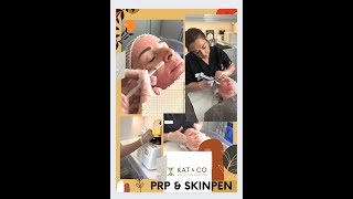 PRP Vampire Facial Treatment Walkthrough at Kat&Co #shorts #prp #aesthetic #fyp