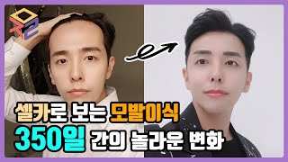 절개 모발이식 350일간의 변화! 1년 경과 L모제림 성형외과(Mojelim) Lm자 탈모,후기 - Youtube