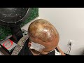 Her hair won’t grow anymore| Alopecia Hair Weave| Alopecia Scarring