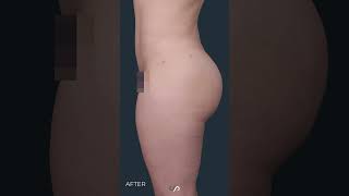 Famous Actress gets a BBL | Sculptra | Dr. Stoker