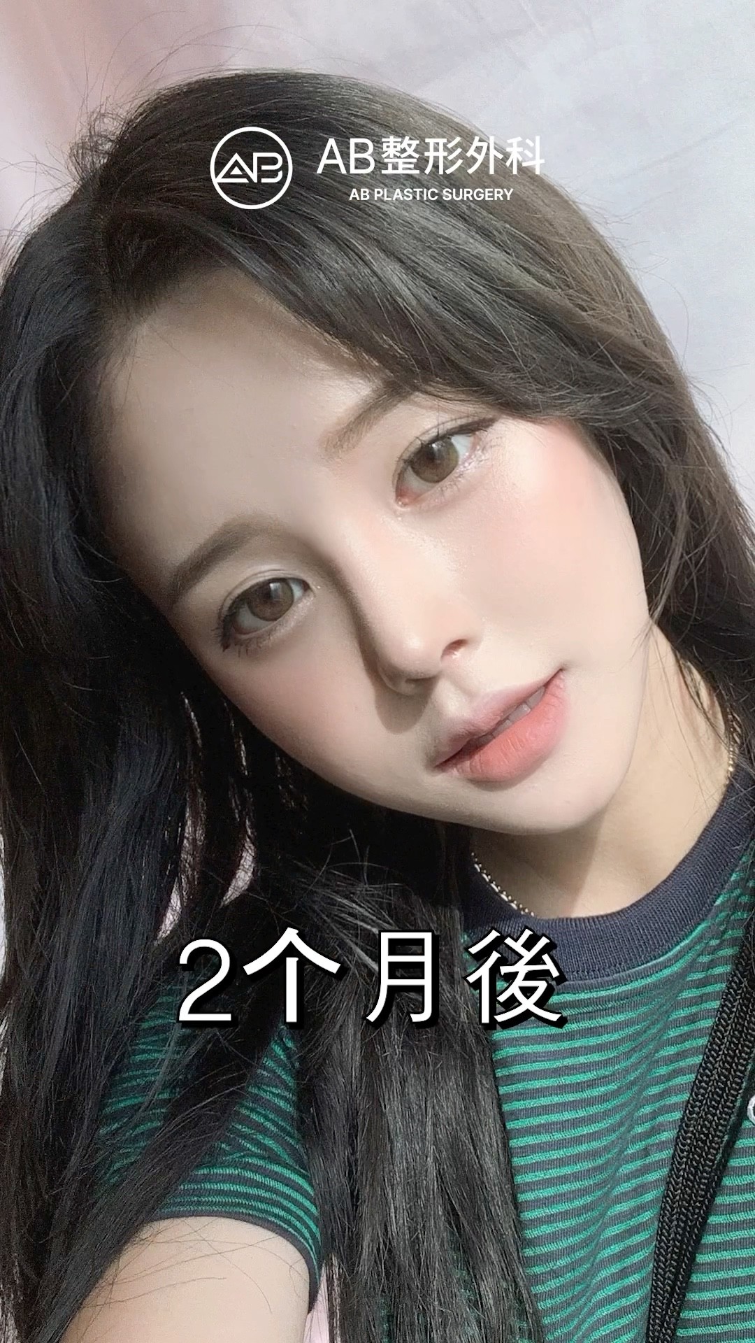 全臉整形前後差太多了 #shorts